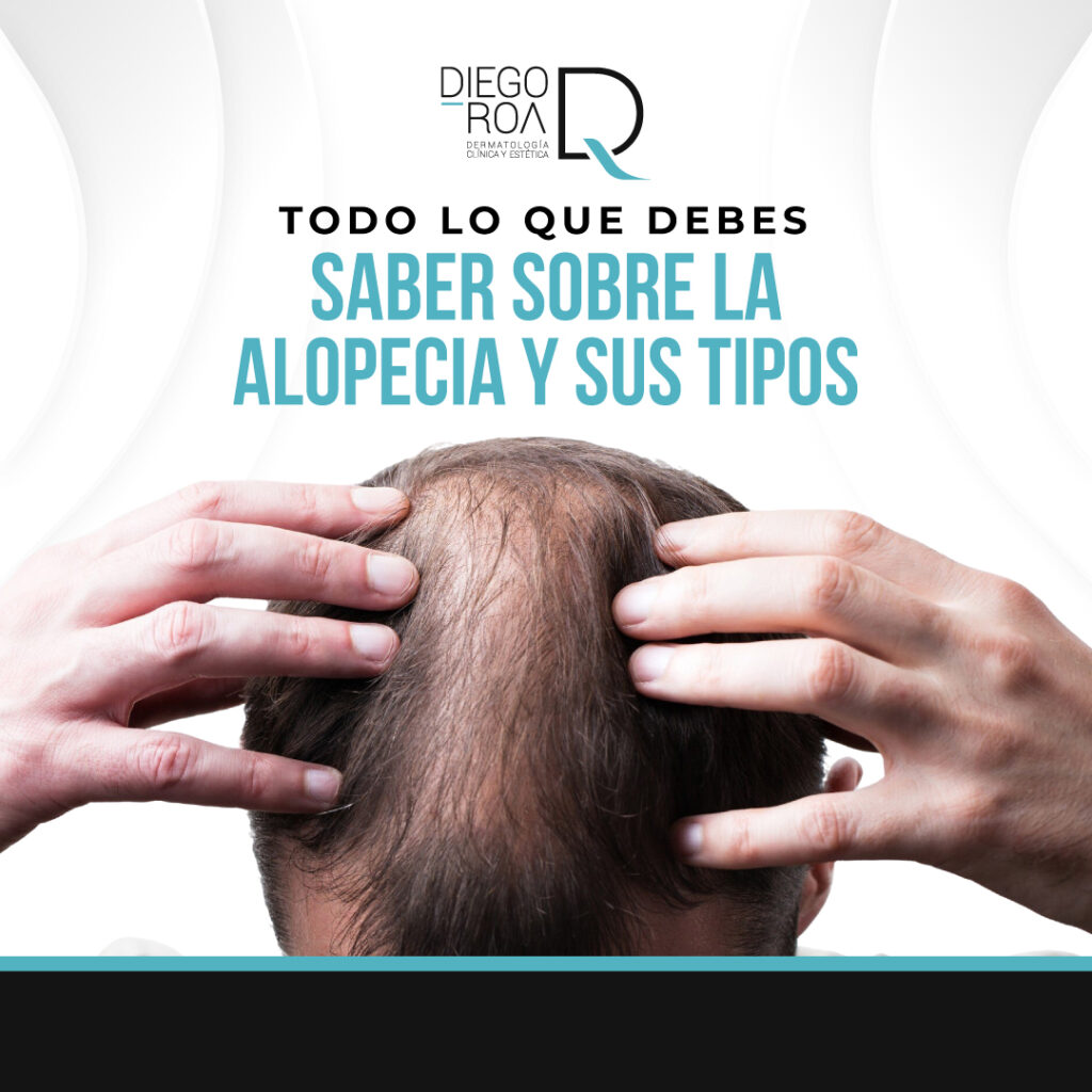 alopecia androgénica