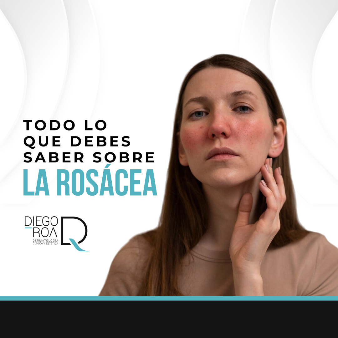 como eliminar la rosácea