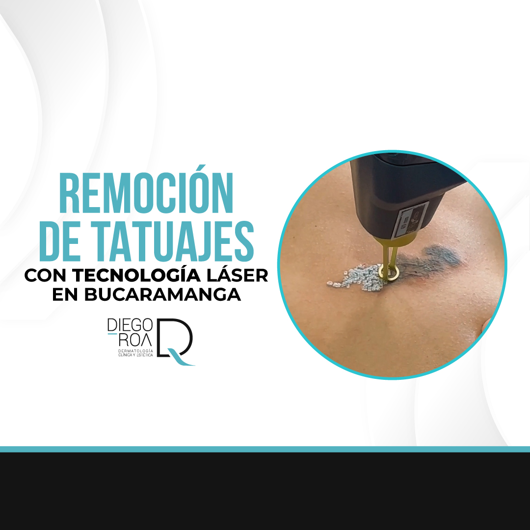 láser para tatuajes en Bucaramanga